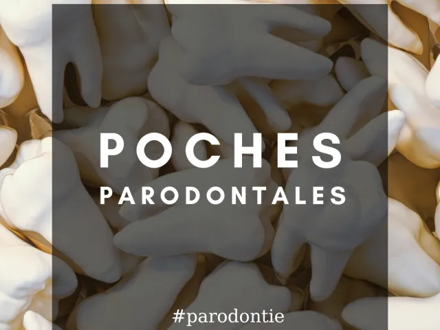 Poches parodontales : quels sont les facteurs prédicteurs de l’aggravation liée au site après un traitement non chirurgical